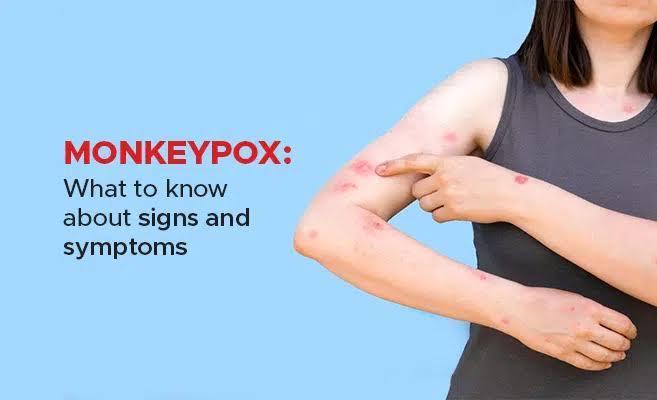 A Simple Guide to Monkey Pox Virus